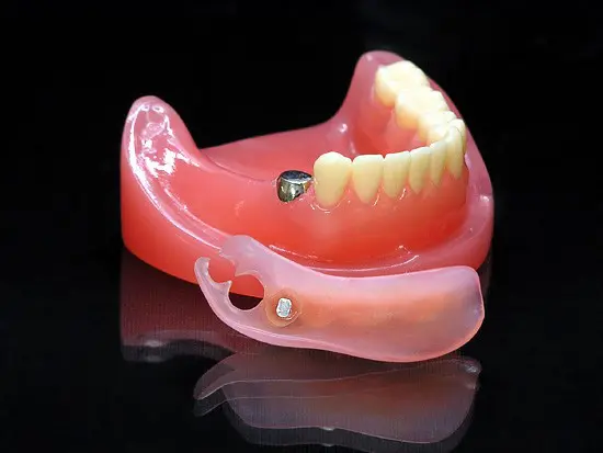 入れ歯8.8万円(税込)～「目立たない・噛める」入れ歯 – 南柏クレイン