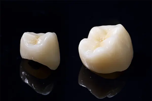 金属アレルギーが生じないセラミック「白い詰め物・被せ物 – 南柏