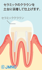 コアの作り方3
